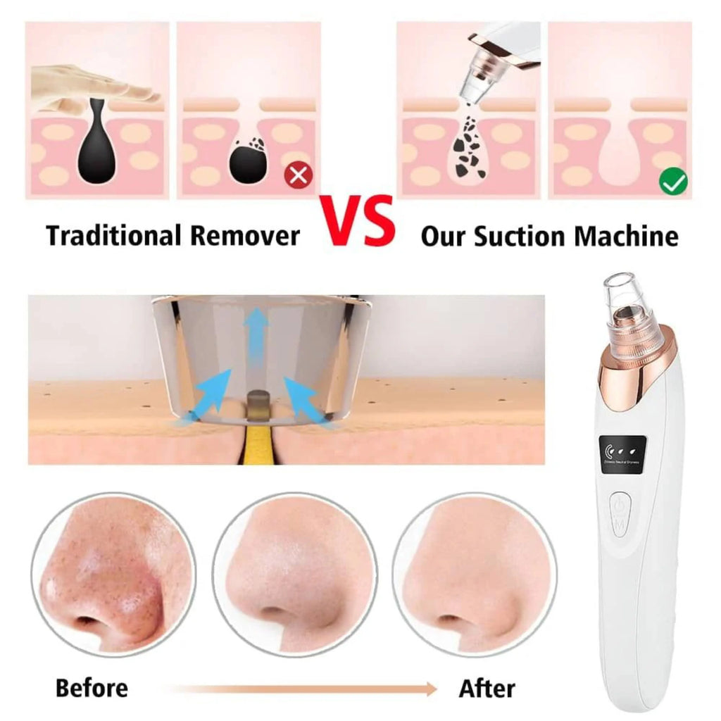 Electric Blackhead Remover Vacuum Pore Cleaner 5 Suction Heads - Front View