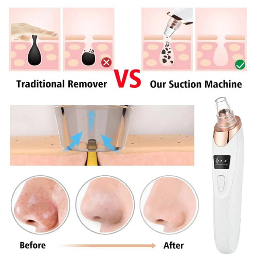 Electric Blackhead Remover Vacuum Pore Cleaner 5 Suction Heads - Front View